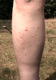 DF wounds to Graham's leg