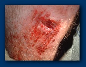 Tim's damaged knee - not treated until the end of the contest